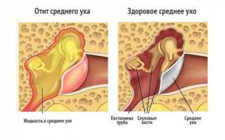 Что надо знать о лечении гнойного отита?
