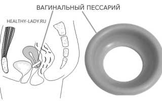 Виды лечения и профилактики пролапса матки