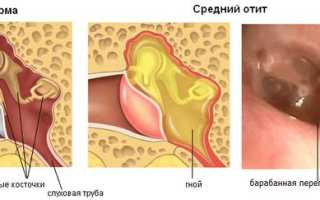 Антибиотики при отите для детей и взрослых какие лучше принимать