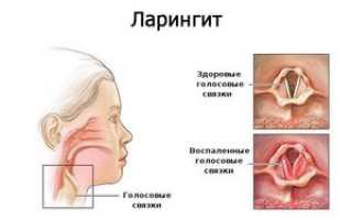 Чем лечить ларингит у взрослых?