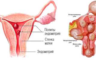 Удаление полипа в матке