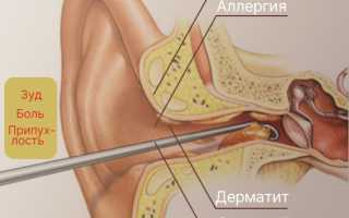 Сильный зуд в ухе: причины и варианты лечения