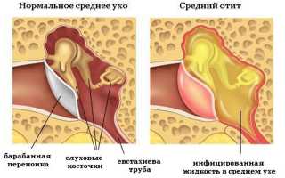 Плюсы и минусы борного спирта при лечении отита