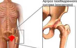 Боль в левом тазобедренном суставе