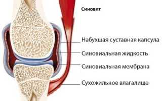 Синовита коленного сустава что это такое