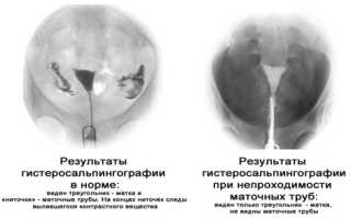 Существующие виды непроходимости маточных труб