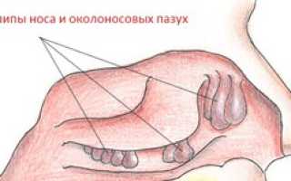 Симптомы и лечение полипов в носу, проведение полипотомии