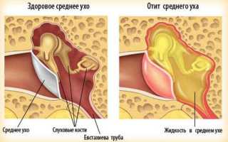 Лечение отита компрессом