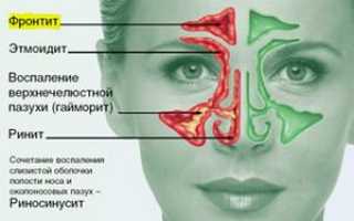 Острый риносинусит: что это такое, симптомы, лечение