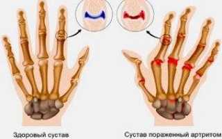 Ревматоидный артрит пальцев рук