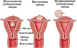 Всё о миоме матки малых размеров