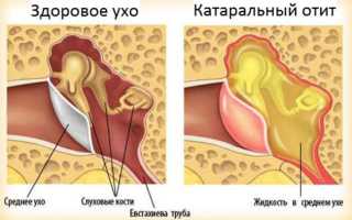 Возможные осложнения отита и как их избежать