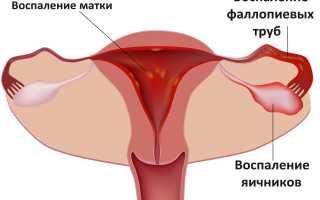 Что такое двухсторонний аднексит