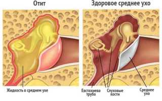 Профилактика отита у детей и взрослых: основные принципы