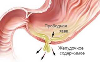 Прободная язва – симптомы и лечение