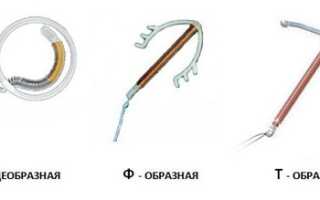Какая внутриматочная спираль лучше?