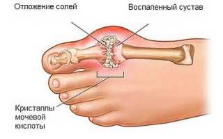Майонез при подагре