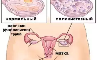 Лечение поликистоза яичников