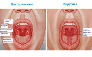 Как выглядит ангина и в чем ее опасность?