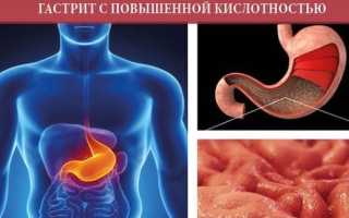 Медикаментозное лечение гастрита с повышенной кислотностью