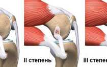 Повреждение боковой связки коленного сустава