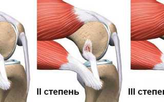 Повреждение боковой связки коленного сустава