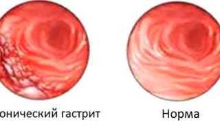 Хронический гастрит
