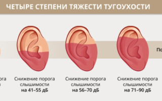 Причины и лечение тугоухости