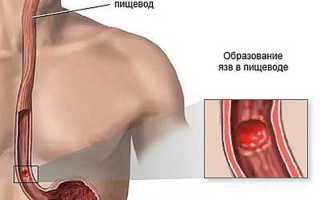 Язва пищевода: симптомы и лечение