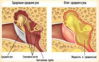 Лечение гнойного отита среднего уха