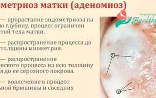 Случаи сочетания миомы матки с аденомиозом