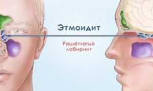 Симптомы и лечение этмоидита и гаймороэтмоидита