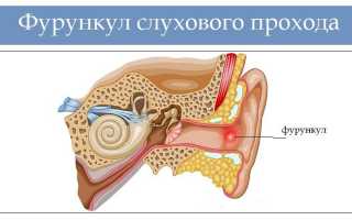 Фурункул в ухе, как лечить?