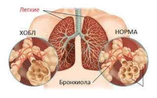 Что это такое — обструкция легких: классификация и лечение