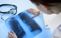 Что такое усиление легочного рисунка на рентгене?