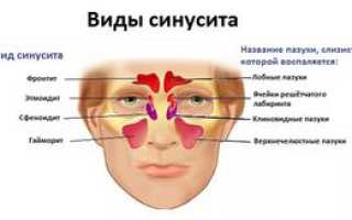 Острый пансинусит и причины его развития, симптомы и лечение