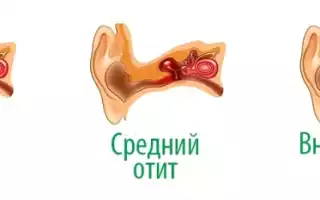 Отит: лечение и частые осложнения у взрослых и детей