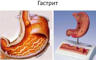 Разнообразие видов гастрита