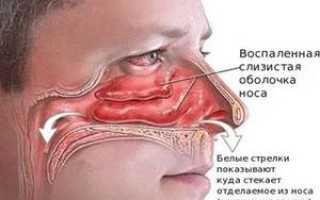 Лечение воспаления слизистой оболочки носа