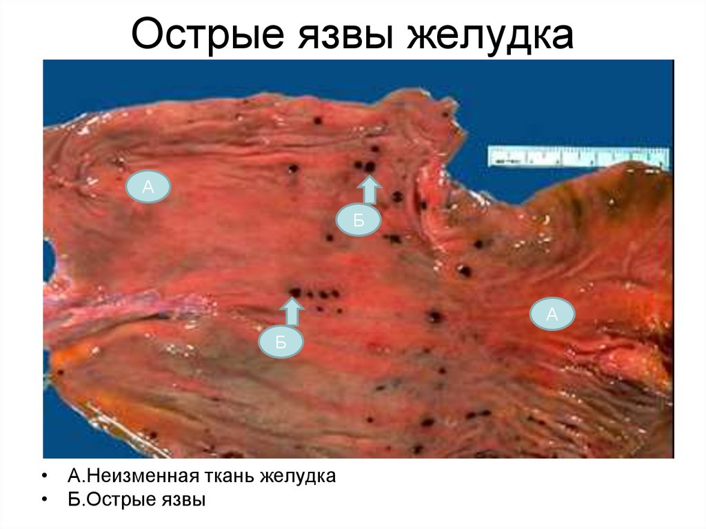 открытая язва желудка