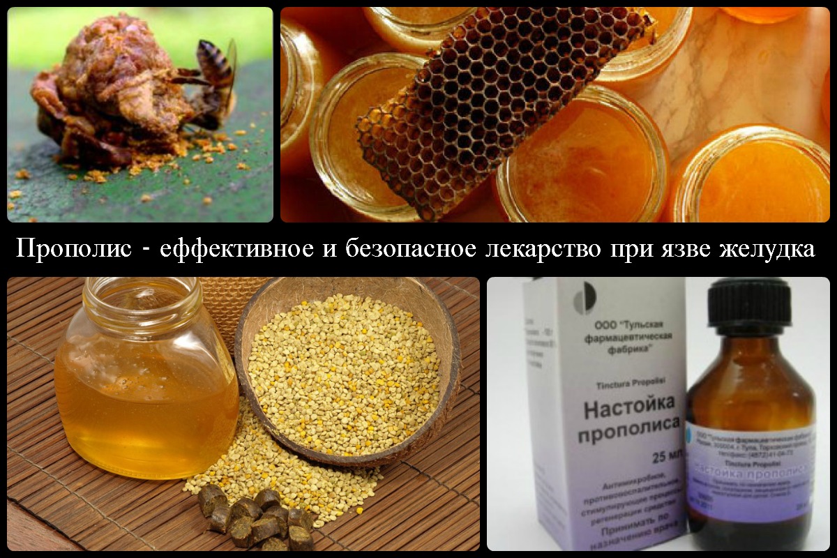 лечение язвы желудка прополисом 