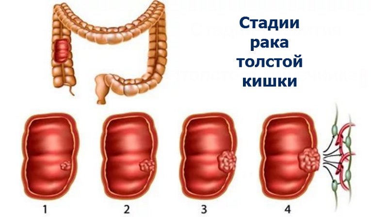 Раковые образования толстого кишечника