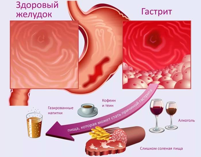 очаговый атрофический гастрит лечение