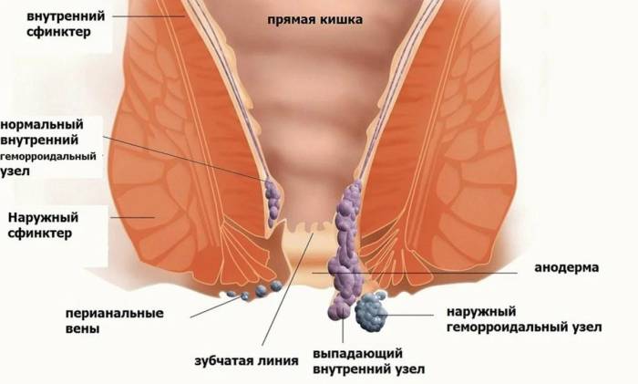 геморрой как лечить