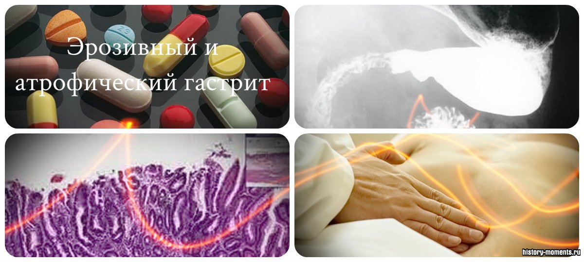 лечение атрофического гастрита желудка 