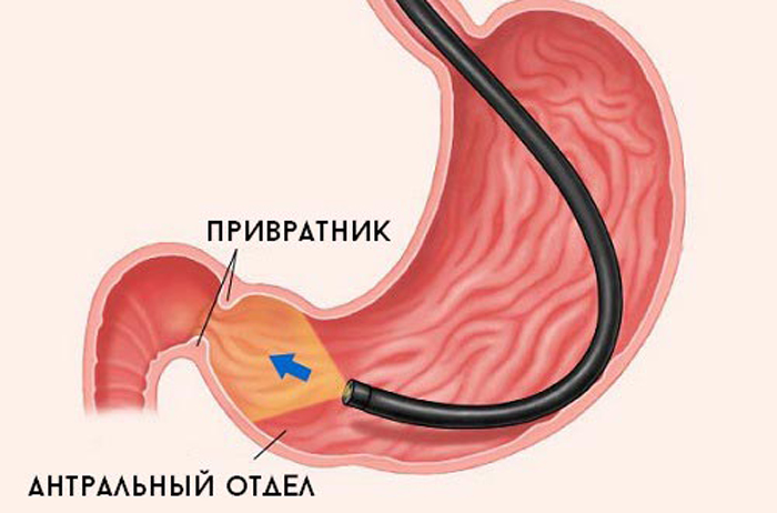 поверхностный гастрит антрального отдела желудка
