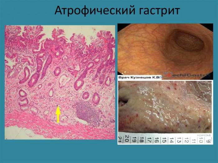 хронический атрофический гастрит