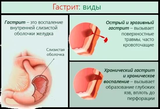 виды гастритов