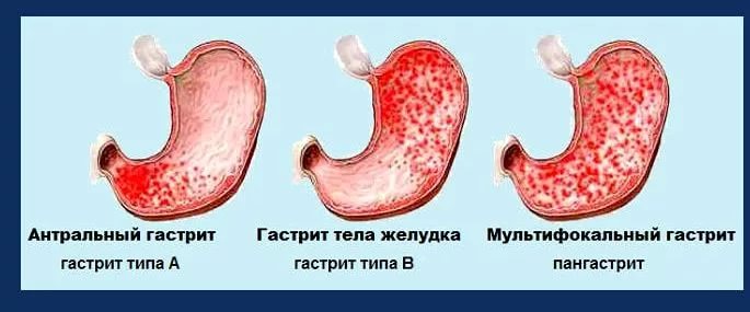 чем лечить гастрит с повышенной кислотностью