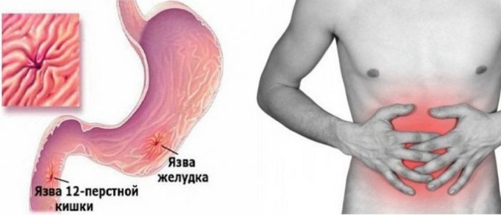 обострение язвы 12 перстной кишки симптомы лечение